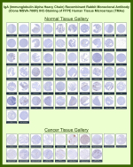 IHC IGHA Antibody for IHC Clone MSVA-700R in human tissue microarrays. Immunohistochemistry analysis of IGHA Antibody for IHC Clone MSVA-700R in formalin-fixed paraffin-embedded human normal and cancer tissue microarrays. The recombinant rabbit monoclonal antibody highlights IgA-producing plasma cells with HRP-DAB brown cytoplasmic staining, consistent with expression of Immunoglobulin alpha heavy chain (IGHA), the heavy chain component of IgA antibodies. Positive plasma cell staining is most prominent in lymphoid and mucosa-associated tissues such as tonsil, gastrointestinal mucosa, and lymph node, reflecting the physiological distribution of IgA-secreting plasma cells in mucosal immunity. Many non-lymphoid tissues show minimal staining except for scattered plasma cells within stromal or inflammatory compartments. The observed staining pattern across normal and tumor tissues is consistent with reported IGHA expression profiles in the Human Protein Atlas.
