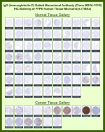 IgD Heavy Chain Antibody for IHC immunohistochemistry analysis of IgD in human tissue microarrays. IgD Heavy Chain Antibody for IHC (clone MSVA-701R) was evaluated on formalin-fixed paraffin-embedded human tissue microarrays containing a broad range of normal and cancer tissues. HRP-DAB chromogenic staining highlights IgD-positive lymphocytes within lymphoid tissues, particularly in mantle zone B cells of tonsil, lymph node, and spleen, while most non-lymphoid tissues show minimal staining. In cancer tissue arrays, staining is primarily observed in infiltrating B lymphocytes within tumor microenvironments rather than tumor epithelial cells. The observed immunohistochemistry patterns are consistent with known IgD / IGHD expression profiles reported in the Human Protein Atlas.