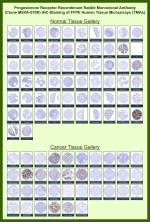 Progesterone receptor Rabbit Recombinant Monoclonal Antibody (MSVA-570R) tested on many normal and cancer tissues. The immunohistochemistry staining in these tissues aligns with the expression data in Human Protein Atlas. <br><br>Manual Protocol: Freshly cut sections should be used (less than 10 days between cutting and staining). Heat-induced antigen retrieval for 5 minutes in an autoclave at 121oC in pH 7.8 Target Retrieval Solution buffer. Apply the antibody at a dilution of 1:150 at 37oC for 60 minutes. Visualization of bound antibody by the EnVision Kit (Dako, Agilent) according to the manufacturer's directions.