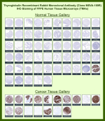Immunohistochemistry analysis of Colloid Protein / Thyroglobulin antibody in human normal and cancer tissue microarrays (clone MSVA-189R). FFPE tissue microarrays demonstrate strong HRP-DAB brown cytoplasmic and luminal staining in normal thyroid gland, with intense chromogenic signal highlighting follicular epithelial cells and colloid material. Non-thyroid normal tissues show minimal to absent staining, consistent with the tissue-restricted expression pattern of Thyroglobulin. In cancer tissues, strong staining is observed in well differentiated thyroid carcinomas, while reduced or absent signal is seen in poorly differentiated or non-thyroid malignancies. The staining distribution aligns with known Thyroglobulin expression patterns and publicly available expression data, supporting specificity for differentiated thyroid epithelium.