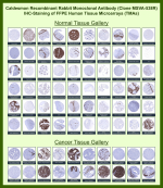 Caldesmon Rabbit Recombinant Monoclonal Antibody (MSVA-538R) tested on many normal and cancer tissues. The immunohistochemistry staining in these tissues aligns with the expression data in Human Protein Atlas. <br><br>Manual Protocol: Freshly cut sections should be used (less than 10 days between cutting and staining). Heat-induced antigen retrieval for 5 minutes in an autoclave at 121oC in pH 7.8 Target Retrieval Solution buffer. Apply the antibody at a dilution of 1:150 at 37oC for 60 minutes. Visualization of bound antibody by the EnVision Kit (Dako, Agilent) according to the manufacturer