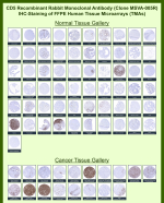 CD5 Antibody for IHC. Immunohistochemistry analysis of CD5 antibody staining in human tissue microarray (TMA) sections using clone MSVA-005R, a recombinant rabbit monoclonal antibody. Strong membranous staining is observed in T cell-rich tissues including tonsil, lymph node, and thymus, with dense labeling of lymphoid zones consistent with CD5 expression on mature T lymphocytes. Within cancer tissue microarrays, prominent staining is seen in lymphoid malignancies such as Hodgkin lymphoma, mantle cell lymphoma, and CD5-positive B cell neoplasms, while most non-hematologic tumors remain negative except for infiltrating immune cells. Across the TMA panel containing a wide range of normal and cancer tissues, staining patterns align with established CD5 biology and publicly available datasets including Human Protein Atlas, supporting the use of this antibody for high-throughput immunohistochemistry and comparative tissue profiling.