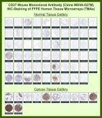 Immunohistochemistry analysis of CD27 for IHC Antibody in FFPE human tissue microarrays (TMAs). CD27 Antibody (clone MSVA-027M) demonstrates membranous HRP-DAB brown staining in lymphocyte-rich tissues including tonsil, lymph node, spleen, and thymus, consistent with CD27 expression on activated and memory T and B lymphocytes. Most non-lymphoid tissues show absent or minimal staining, supporting expected tissue-restricted expression. In cancer tissue arrays, CD27-positive tumor-infiltrating lymphocytes are observed in multiple malignancies, while strong staining is seen in lymphoid neoplasms consistent with B-cell lineage origin. The overall immunohistochemical pattern aligns with publicly available expression profiles, including data reported in the Human Protein Atlas.