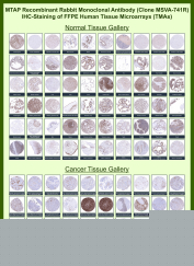 MTAP Antibody for IHC Tissue Microarray (TMA). Immunohistochemistry analysis of Methylthioadenosine phosphorylase (MTAP) across human tissue microarray (TMA) panels using MTAP antibody clone MSVA-741R. Formalin-fixed, paraffin-embedded human tissue microarrays containing a wide range of normal and cancer tissues show predominantly cytoplasmic staining in normal tissues, while many tumor samples demonstrate reduced or absent expression. The staining pattern highlights differential MTAP expression between normal and malignant tissues, consistent with its role in cellular metabolism and tumor-associated gene loss.