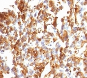 IHC analysis of FFPE human melanoma stained with Vimentin antibody (clone VIM66-1).