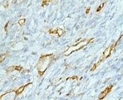 IHC testing of FFPE colon carcinoma and CD31 antibody (clone PCM25-1). Staining of formalin-fixed tissues requires boiling tissue sections in 1mM EDTA, pH 7.5-8.5, for 10-20 min followed by cooling at RT for 20 minutes.