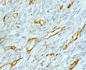 IHC testing of FFPE colon carcinoma and CD31 antibody (clone PCM25-1). Staining of formalin-fixed tissues requires boiling tissue sections in 1mM EDTA