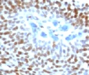 IHC staining of FFPE human colon carcinoma with p53 antibody (clone CTA53-1). FFPE testing requires sections to be boiled in pH 9 10mM Tris with 1mM EDTA for 10-20 minutes, followed by cooling at RT for 20 minutes, prior to staining.