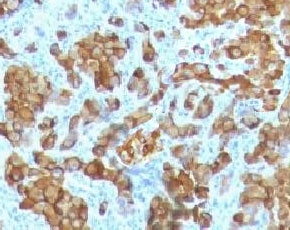 IHC: Formalin-fixed, paraffin-embedded human melanoma stained with Melan-A antibody (clione MRT3V). HIER: boil tissue sections in pH 9 10mM Tris with 1mM EDTA for 10-20 min followed by cooling at RT for 20 min.