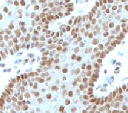 IHC testing of FFPE human cervical carcinoma and c-Myc antibody (clone MVH39-1). Staining of formalin-fixed tissues requires boiling tissue sections in 10mM Tris with 1mM EDTA, pH 9.0, for 10-20 min followed by cooling at RT for 20 min.~