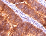 IHC testing of FFPE colon carcinoma and MUC-1 antibody (clone MCN01-1).