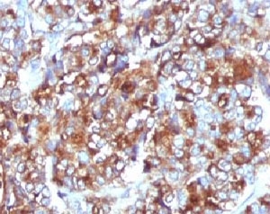 IHC testing of FFPE breast carcinoma and MUC-1 antibody (clone MCN01-1).~