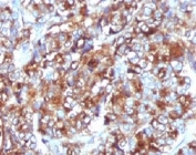 IHC testing of FFPE breast carcinoma and MUC-1 antibody (clone MCN01-1).