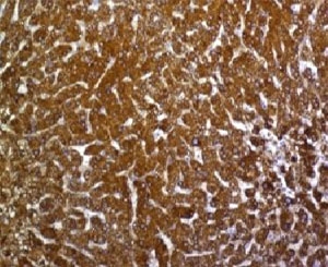 IHC testing of FFPE human hepatocellular carcinoma with Glypican-3 antibody (clone SGPN3-1).~