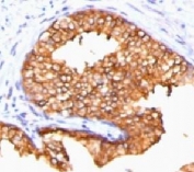 IHC testing of FFPE human prostate carcinoma and ODC antibody (clone ORN255-1). Required HIER: boil tissue sections in pH 9 10mM Tris with 1mM EDTA for 10-20 min.