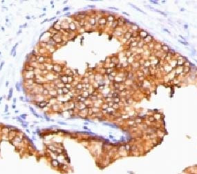 IHC testing of FFPE human prostate carcinoma and ODC antibody (clone ORN255-1). Required HIER: boil tissue sections in pH 9 10mM Tris with 1mM