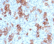 IHC testing of FFPE human Hodgkin's lymphoma and CD30 antibody (clone CDLA30-1).