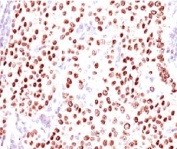 IHC testing of FFPE human breast carcinoma with Progesterone Receptor antibody (clone PGSR17). Required HIER: boil tissue sections in pH 9 10mM Tris with 1mM EDTA for 10-20 min followed by cooling at RT for 20 minutes.