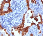 IHC testing of FFPE human lung carcinoma stained with Cytokeratin 8 antibody (clone CYKN8-1). Required HIER: boil tissue sections in 10mM citrate buffer, pH 6, for 10-20 min followed by cooling at RT for 20 min.