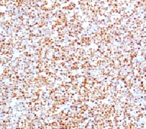 IHC testing of human mantle cell lymphoma and Cyclin D1 antibody (clone BCLD1-1).~