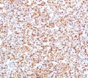 IHC testing of human mantle cell lymphoma and Cyclin D1 antibody (clone BCLD1-1).