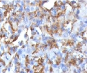 IHC testing of human histiocytoma tissue and CD68 antibody (CDLA68-1). HIER: staining of formalin/paraffin tissues requires boiling tissue sections in 10mM citrate buffer, pH 6, for 10-20 min followed by cooling at RT for 20 min.