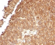 IHC testing of FFPE human melanoma with TOP1MT antibody (clone TPIMT-1). Staining of formalin/paraffin tissues requires boiling tissue sections in pH 9 10mM Tris with 1mM EDTA for 10-20 min followed by cooling at RT for 20 min.