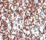 IHC testing of FFPE human Rhabdomyosarcoma with PAX7 antibody (clone PBPX7). Required HIER: boil tissue sections in 10mM Tris buffer with 1mM EDTA, pH 9, for 10-20 min followed by cooling at RT for 20 min.