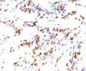 IHC testing of FFPE human colon carcinoma and p27Kip1 antibody (clone KIP27-1). Staining of formalin-fixed tissues requires boiling tissue sections in pH 9 10mM Tris with 1mM EDTA for 10-20 min followed by cooling at RT for 20 min.