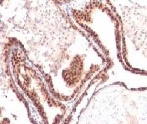 IHC testing of FFPE human prostate cancer and p27Kip1 antibody (clone KIP27-1). Staining of formalin-fixed tissues requires boiling tissue sections in pH 9 10mM Tris with 1mM EDTA for 10-20 min followed by cooling at RT for 20 min.~