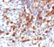 IHC testing of FFPE human lymphoma and CD79a antibody (clone CDLA79a-1). HIER: formalin-fixed tissues requires boiling tissue sections in pH 9 10mM Tris with 1mM EDTA, for 10-20 min followed by cooling at RT for 20 min.