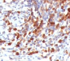 IHC testing of FFPE human lymphoma and CD79a antibody (clone CDLA79a-1). HIER: formalin-fixed tissues requires boiling tissue sections in pH 9 10mM Tris with 1mM EDTA, for 10-20 min followed by cooling at RT for 20 min.~