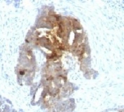IHC testing of human ovarian carcinoma with TAG-72 antibody (clone TAGP-4).