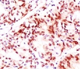 IHC testing of ovarian cancer stained with Estrogen Receptor beta antibody (clone NR3Gb-1).~