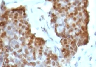IHC testing of gastric carcinoma stained with Estrogen Receptor beta antibody (clone NR3Gb-1).