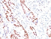 IHC testing of human colon carcinoma and p57 antibody (clone KIP57-1). Staining of formalin-fixed tissues requires boiling tissue sections in pH 9 10mM Tris with 1mM EDTA for 10-20 min followed by cooling at RT for 20 min.