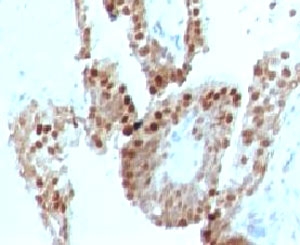 IHC testing of human prostate carcinoma and p57 antibody (clone KIP57-1). Staining of formalin-fixed tissues requires boiling tissue sections in pH 9 10mM Tris with 1mM EDTA for 10-20 min followed by cooling at RT for 20 min.~