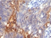 IHC testing of FFPE human colon carcinoma and Secretory Component Glycoprotein antibody (clone SRGP85). Staining of formalin-fixed tissues requires boiling tissue sections in pH 9 10mM Tris with 1mM EDTA for 10-20 min followed by cooling at RT for 20 min.