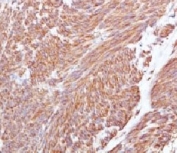 IHC testing of FFPE human gastrointestinal stromal tumor (GIST) and CD117 antibody (clone CLDA117). Required HIER: boil tissue sections in pH 9 10mM Tris with 1mM EDTA for 10-20 min followed by cooling at RT for 20 min.