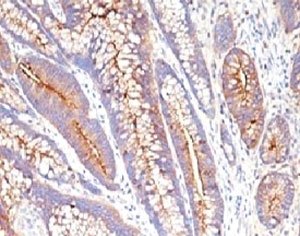 FFPE staining of human colon carcinoma with CEA antibody (CCM661).