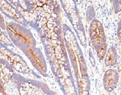 CEA antibody C66/1009 IHC of human colon carcinoma