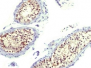 IHC testing of FFPE human testicular carcinoma and Thymidylate Synthase antibody (clone TYSY9). HIER: boil tissue sections in pH 9 10mM Tris with 1mM EDTA for 10-20 min followed by cooling at RT for 20 minutes.