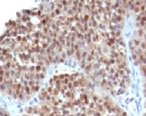 IHC testing of human bladder carcinoma and p21 antibody (WAF21-1). Staining of formalin-fixed tissues requires boiling tissue sections in pH 9 10mM Tris with 1mM EDTA for 10-20 min followed by cooling at RT for 20 min~