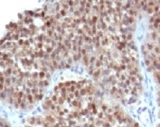 IHC testing of human bladder carcinoma and p21 antibody (WAF21-1). Staining of formalin-fixed tissues requires boiling tissue sections in pH 9 10mM Tris with 1mM EDTA for 10-20 min followed by cooling at RT for 20 min