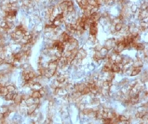 IHC testing of FFPE human renal cell carcinoma and Cadherin 16 antibody (clone KSCP2). Staining of formalin-fixed tissues requires boiling tissue sections in 10mM Tris with 1mM EDTA, pH 9.0, for 10-20 min followed by cooling at RT for 20 min.~