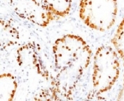 IHC testing of FFPE human lung tissue with TTF-1 antibody (clone HBNK2-1). Required HIER: boil FFPE tissue sections in pH6 10mM citrate buffer for 10-20 minutes, followed by cooling at RT for 20 minutes.