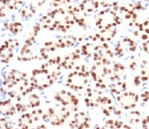 IHC testing of FFPE human thyroid tissue with TTF-1 antibody (clone HBNK2-1). Required HIER: boil FFPE tissue sections in pH6 10mM citrate buffer for 10-20 minutes, followed by cooling at RT for 20 minutes.~