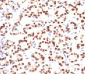 IHC testing of FFPE human thyroid tissue with TTF-1 antibody (clone HBNK2-1). Required HIER: boil FFPE tissue sections in pH6 10mM citrate buffer for 10-20 minutes, followed by cooling at RT for 20 minutes.
