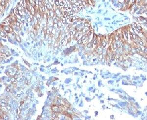 IHC testing of FFPE human esophageal carcinoma and TRIM29 antibody (clone TPMP29-1). FFPE testing requires sections to be boiled in pH 9 10mM Tris with 1mM EDTA for 10-20 minutes, followed by cooling at RT for 20 minutes, prior to staining.~