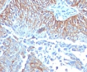 IHC testing of FFPE human esophageal carcinoma and TRIM29 antibody (clone TPMP29-1). FFPE testing requires sections to be boiled in pH 9 10mM Tris with 1mM EDTA for 10-20 minutes, followed by cooling at RT for 20 minutes, prior to staining.